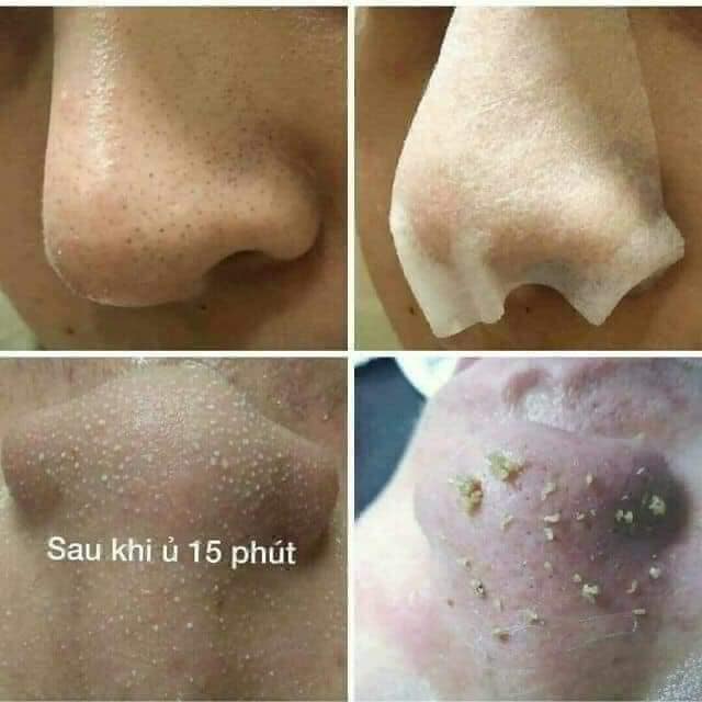 Dung dịch ủ mụn Medipeel Extra Super 9